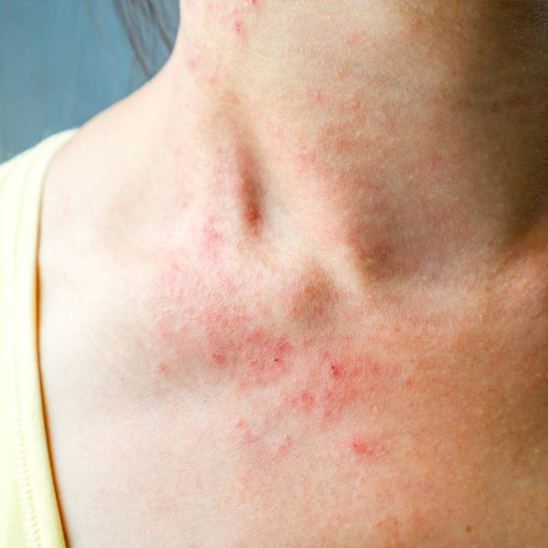 Neck with red rash and irritation.