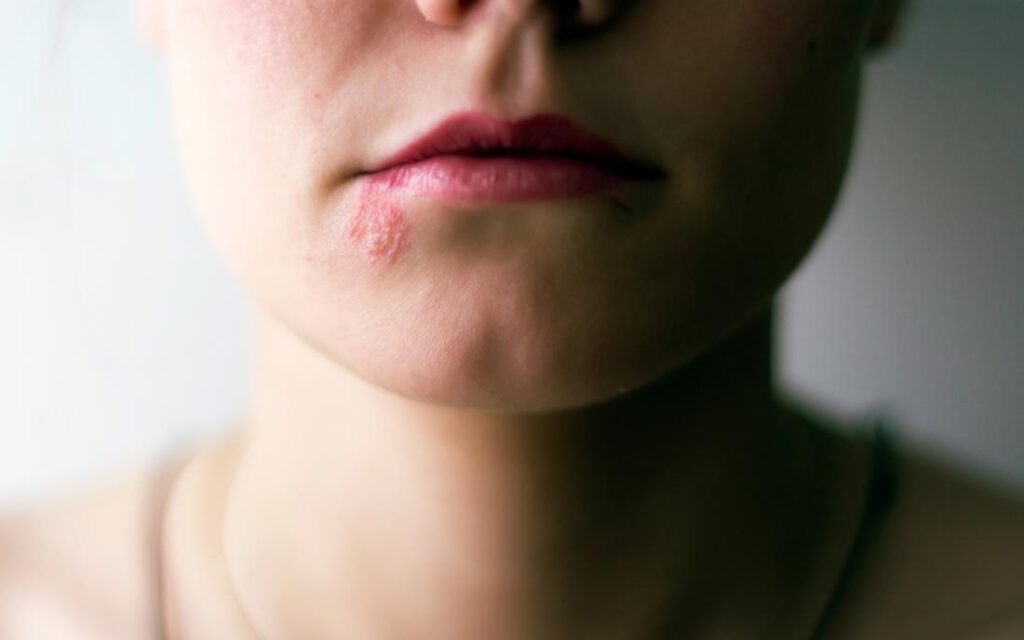 Agurzil natural treatment cure for pimples, moles to get clear skin